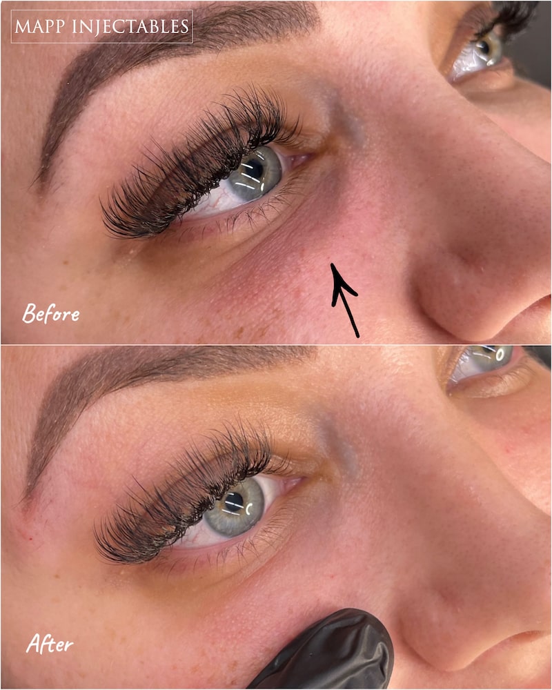 Filler Dissolving Injections What you need to know